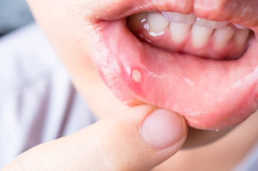 Mouth Ulcers Treatment